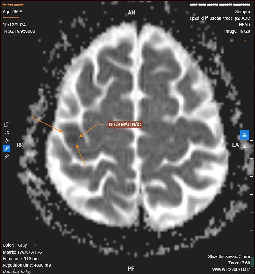 Cẩn trọng với nguy cơ đột quỵ trong mùa đông
