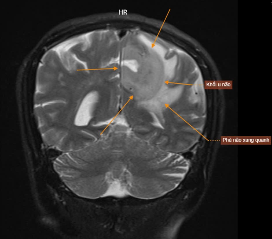 PHÁT HIỆN SỚM U NÃO NHỜ CÔNG NGHỆ CHỤP MRI