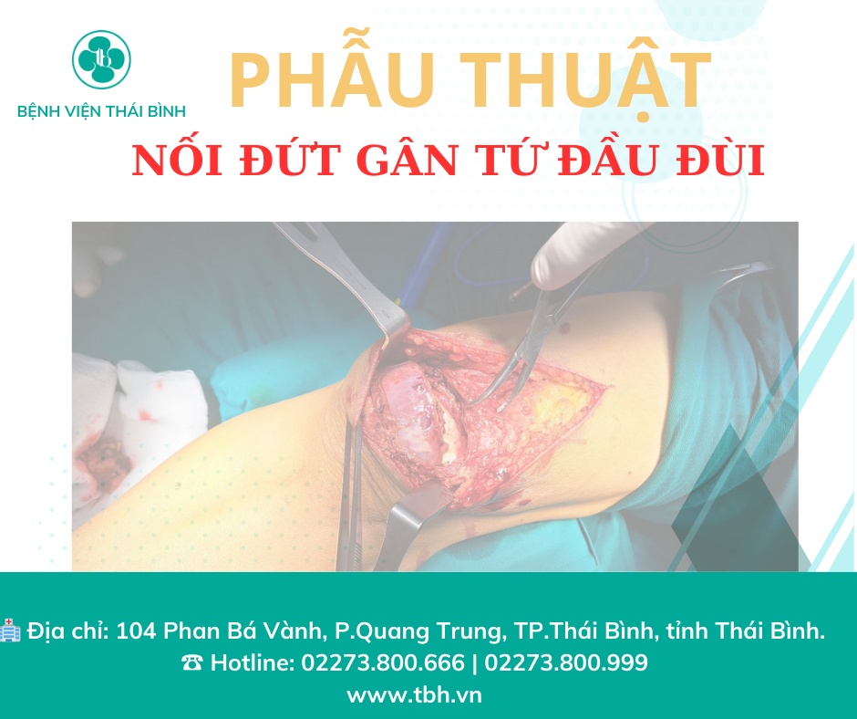 PHẪU THUẬT NỐI ĐỨT GÂN TỨ ĐẦU ĐÙI TẠI BVTB